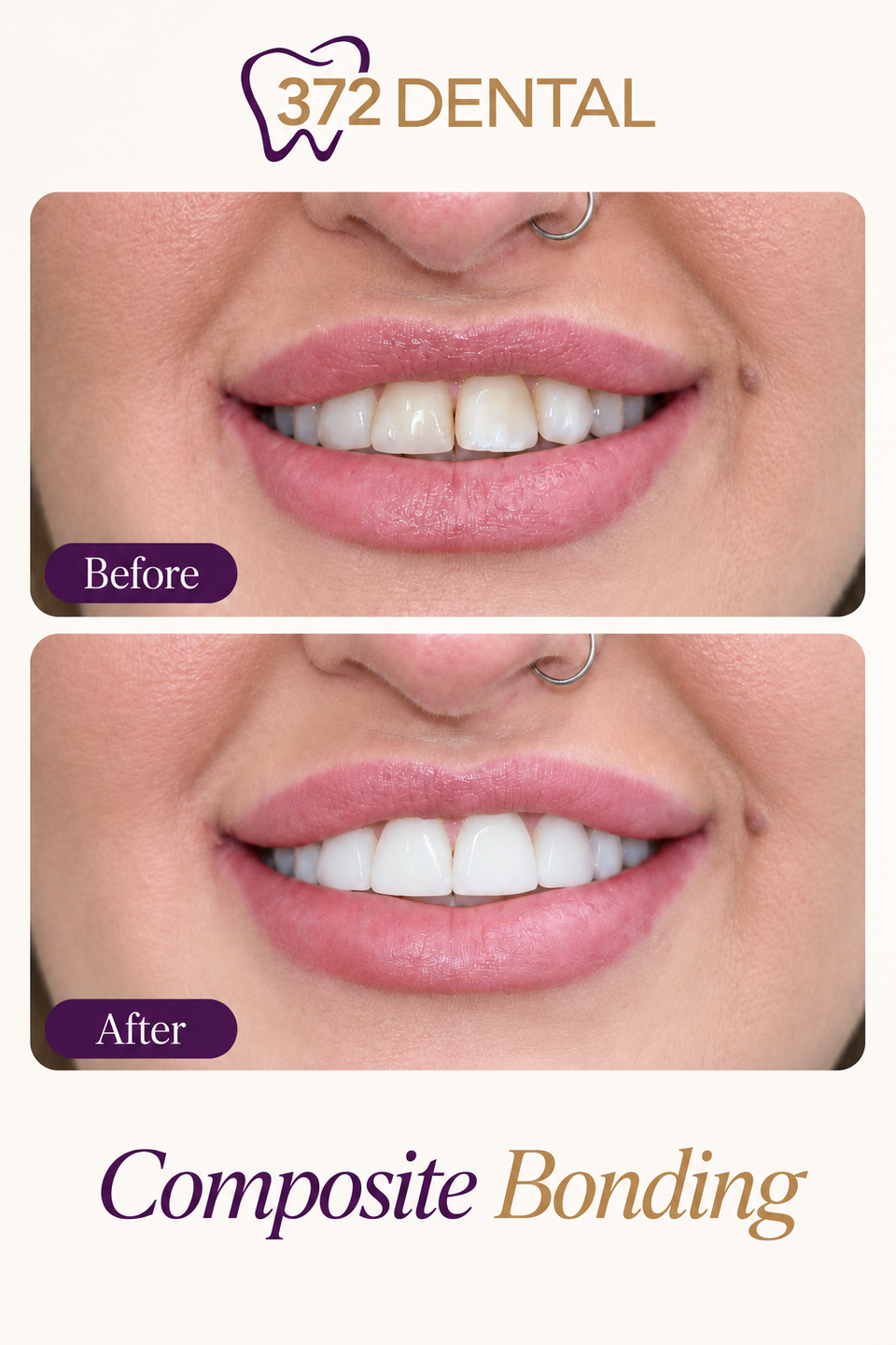 Composite bonding before and after — example 1, provided by 372 Dental, treatment by Dr Rabia Maqsood