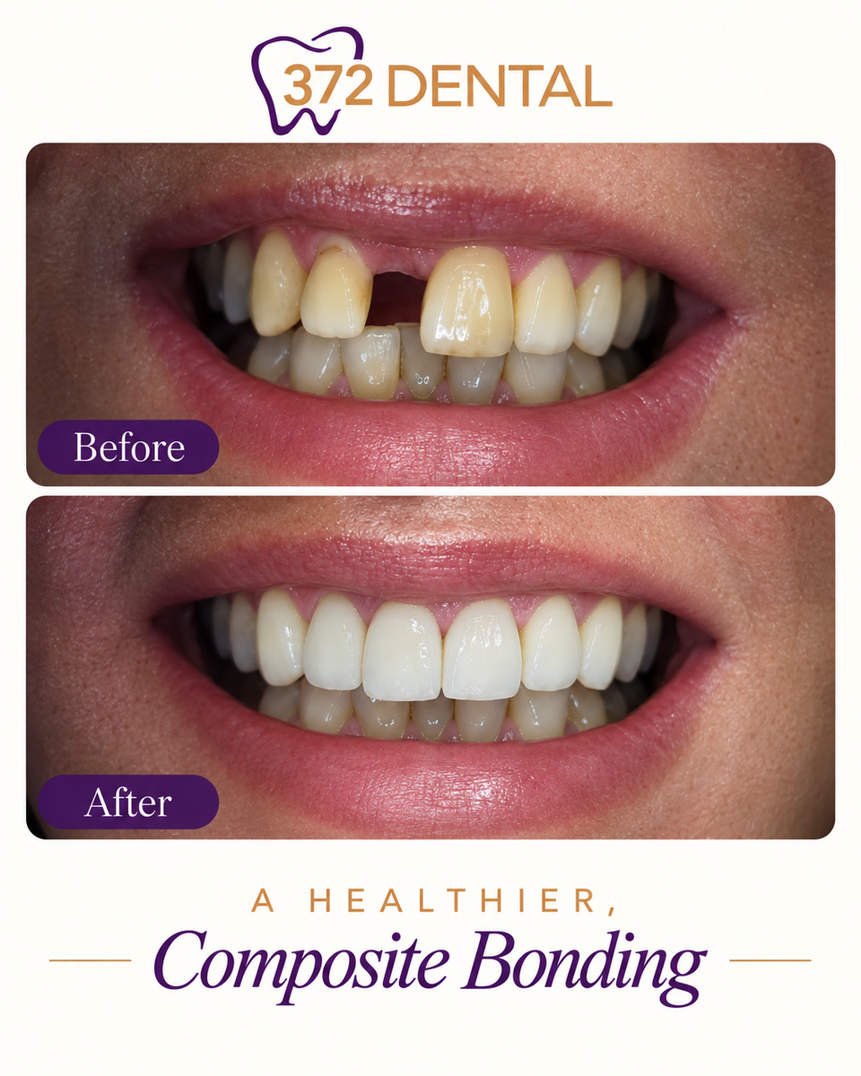 Composite bonding before and after — example 3, provided by 372 Dental, treatment by Dr Rabia Maqsood