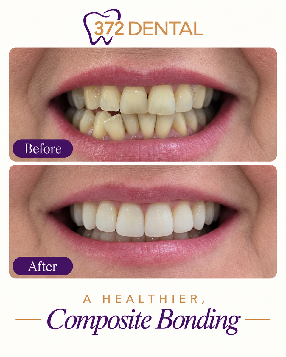 Composite bonding before and after — example 4, provided by 372 Dental, treatment by Dr Rabia Maqsood