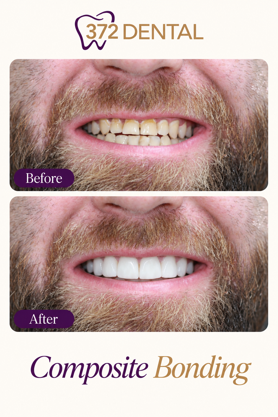 Composite bonding before and after, treatment by Dr Rabia Maqsood