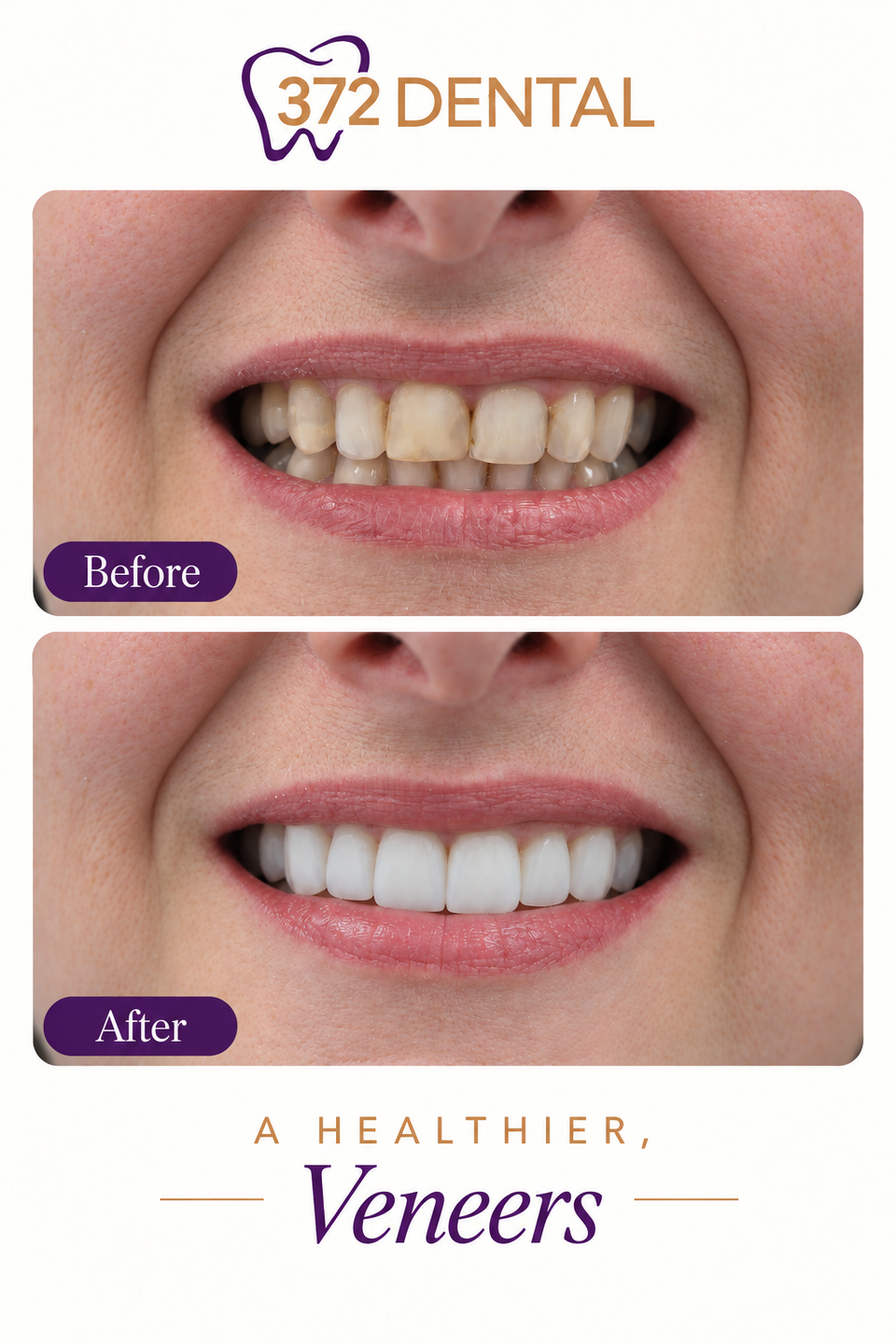 Veneers before and after — treatment example 1 supplied by 372 Dental