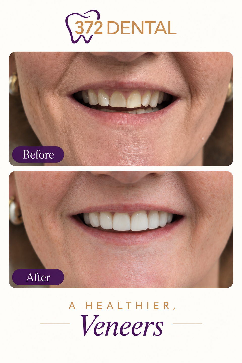 Veneers before and after — treatment example 2 supplied by 372 Dental