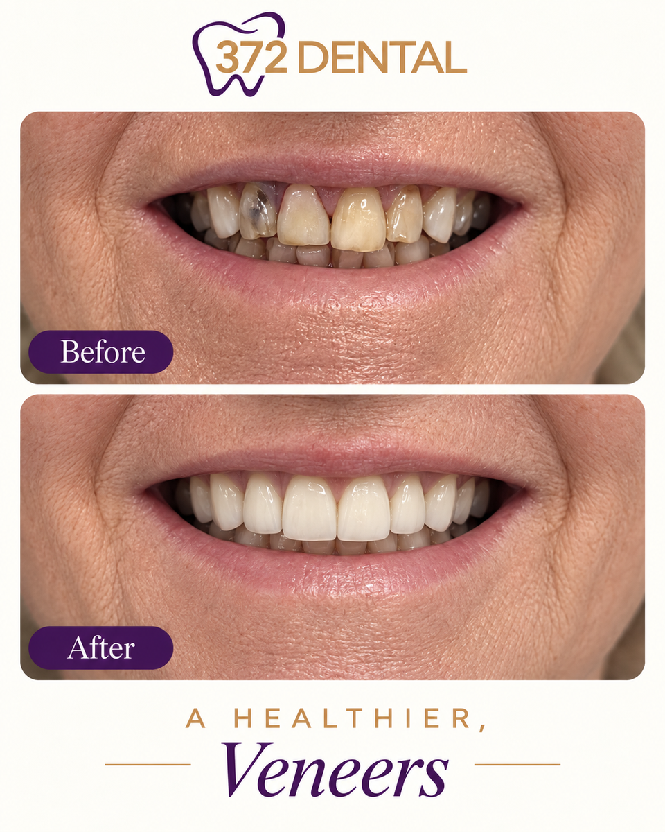 Veneers before and after — treatment example 3 supplied by 372 Dental